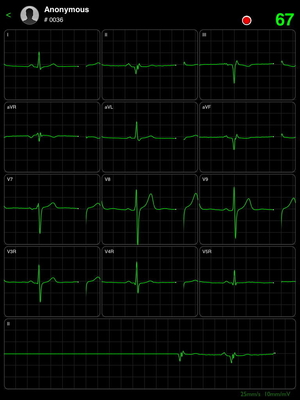 ICV200 IPad ECG Machine Smart Wireless Bluetooth White Recorder