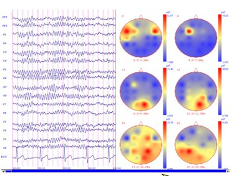 24 channel Ambulatory EEG Equipment